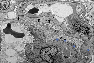 Case Report: Novel Dietary Supplementation Associated With Kidney Recovery and Reduction in Proteinuria in a Dialysis Dependent Patient Secondary to Steroid Resistant Minimal Change Disease